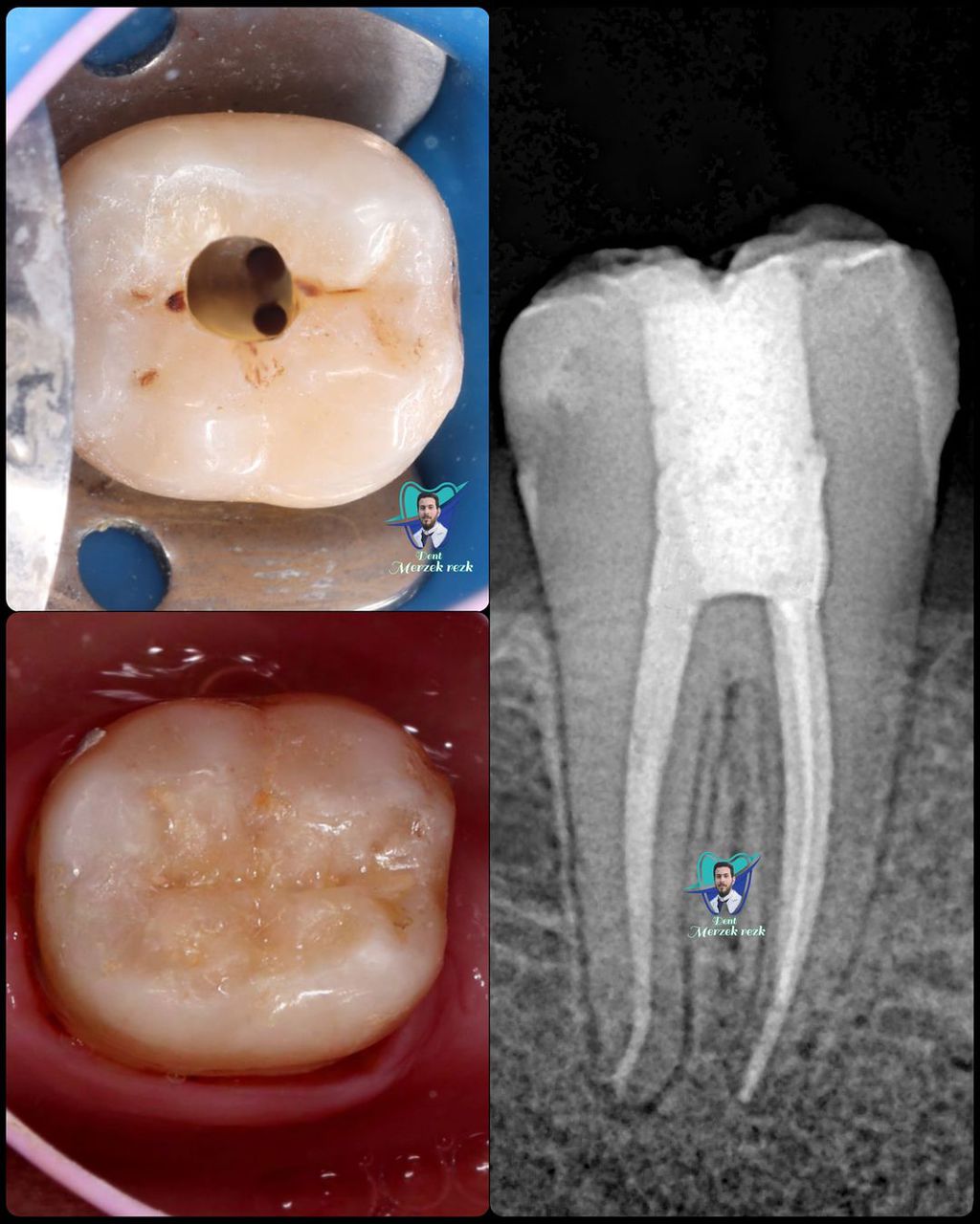 Illustration d'un alignement orthodontique précis pour un sourire harmonieux.